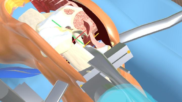 Knee replacement simulation: cutting the bone with a guide