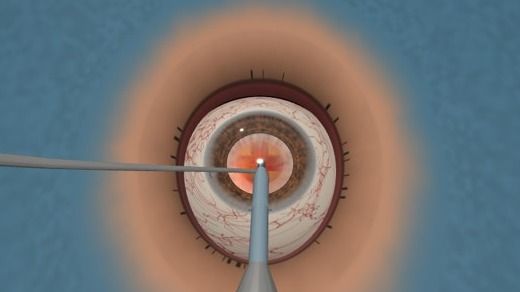 Cataract surgery simulation through the microscope